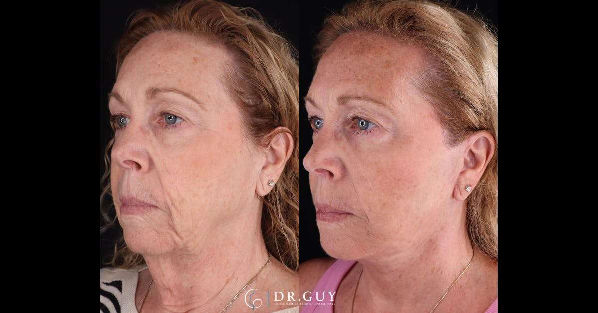 Facelift Before & After Gallery - Patient 209651 - Image 3