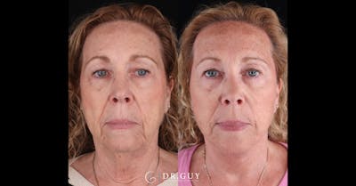 Facelift Before & After Gallery - Patient 209651 - Image 1