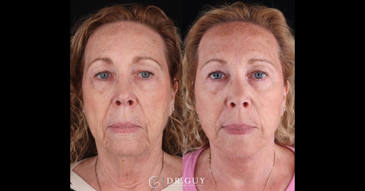 Facelift Before & After Gallery - Patient 209651 - Image 1