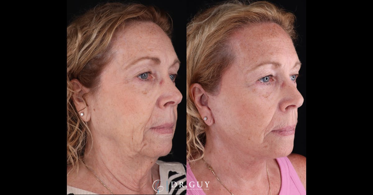 Facelift Before & After Gallery - Patient 209651 - Image 2