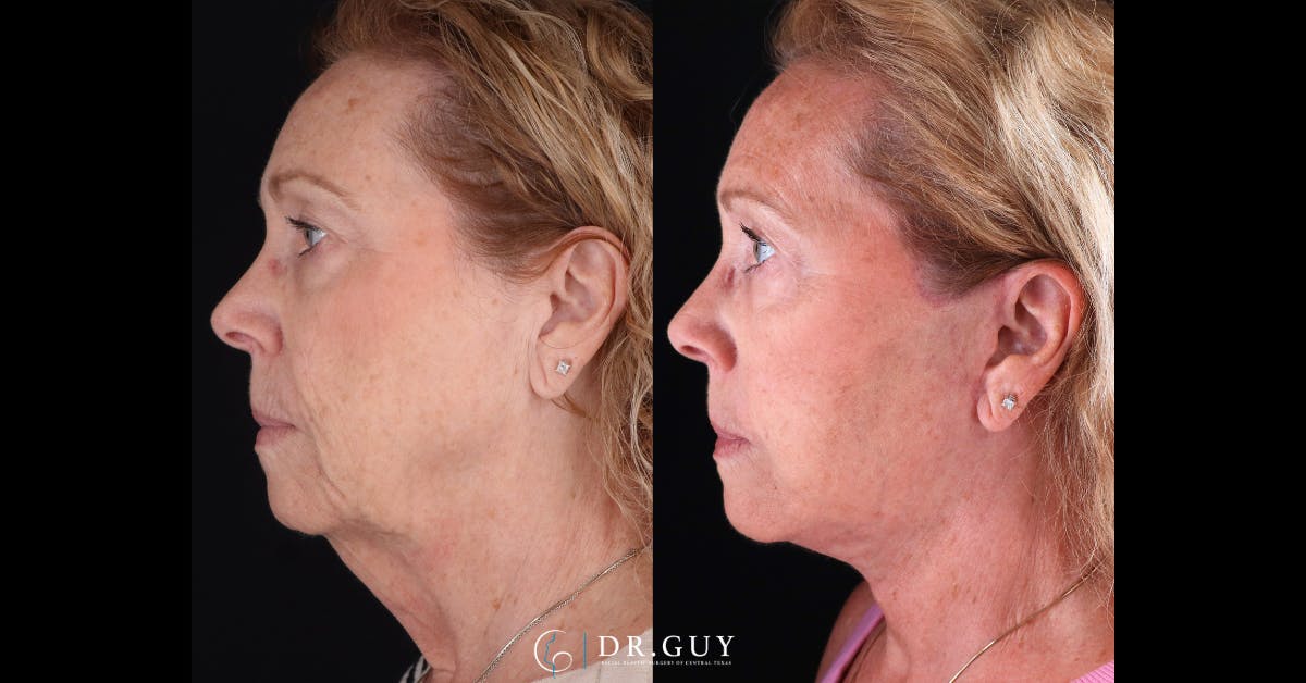 Facelift Before & After Gallery - Patient 209651 - Image 4