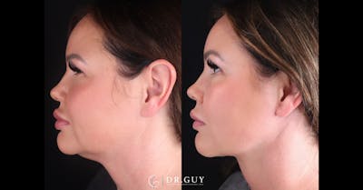 Neck Lift Before & After Gallery - Patient 395205 - Image 1