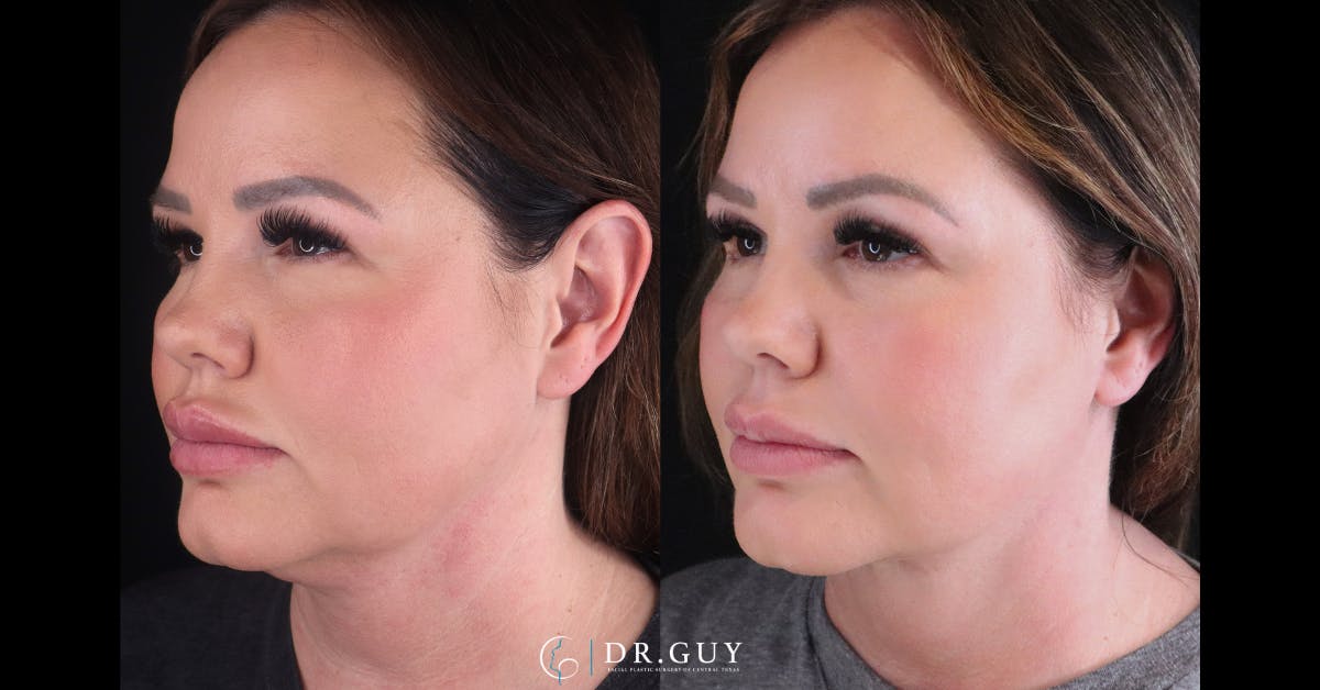 Neck Lift Before & After Gallery - Patient 395205 - Image 2