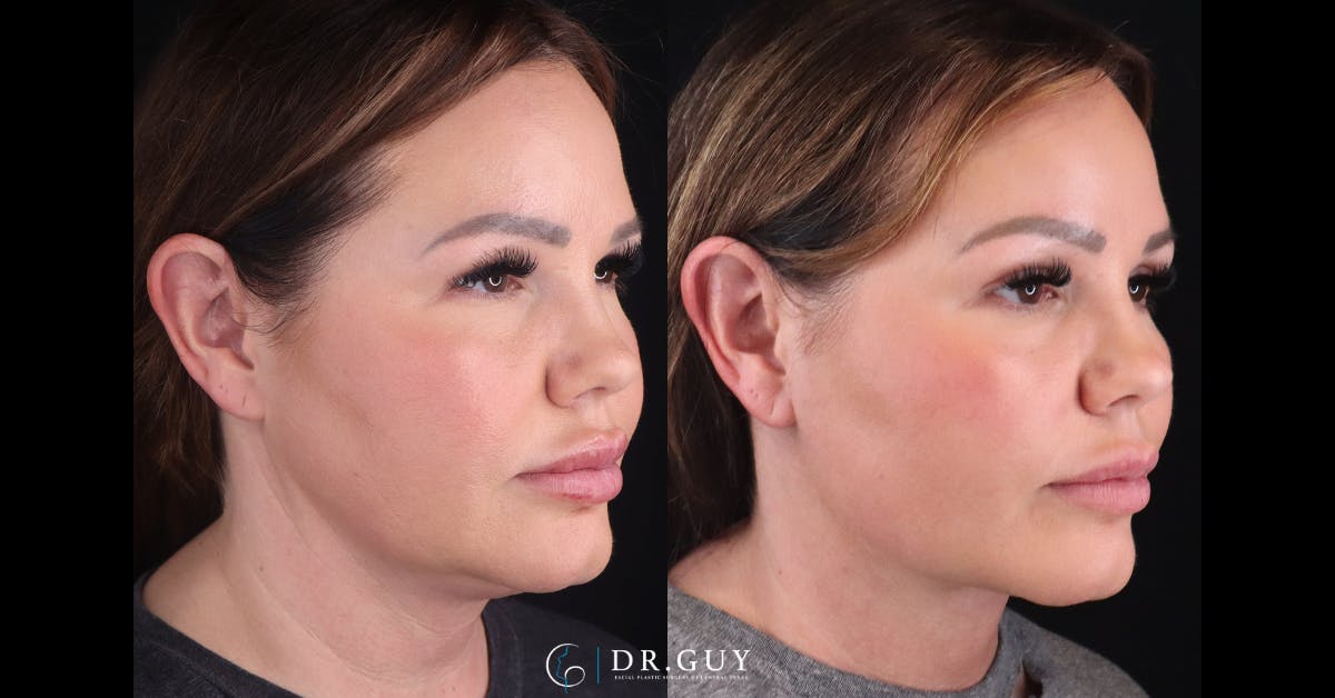 Neck Lift Before & After Gallery - Patient 395205 - Image 3
