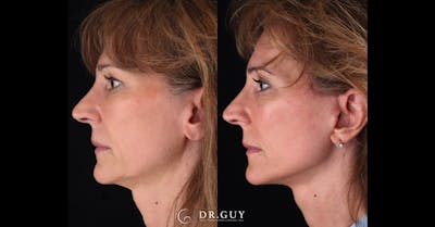 Mini Facelift Before & After Gallery - Patient 248444 - Image 1