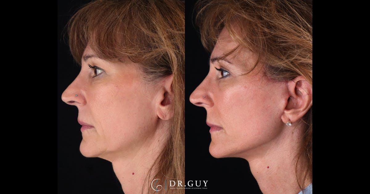 Mini Facelift Before & After Gallery - Patient 248444 - Image 1