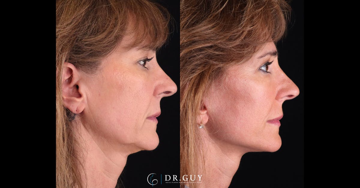Mini Facelift Before & After Gallery - Patient 248444 - Image 4