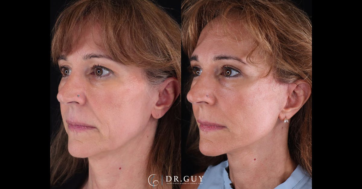 Mini Facelift Before & After Gallery - Patient 248444 - Image 2