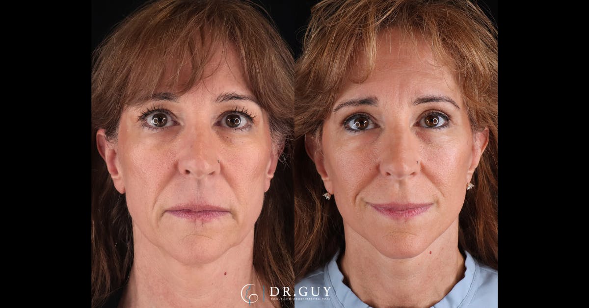 Mini Facelift Before & After Gallery - Patient 248444 - Image 3