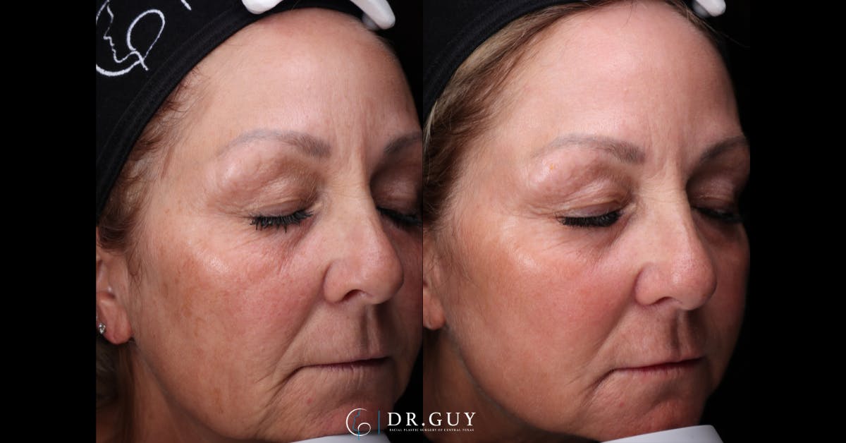 Laser Before & After Gallery - Patient 468220 - Image 2