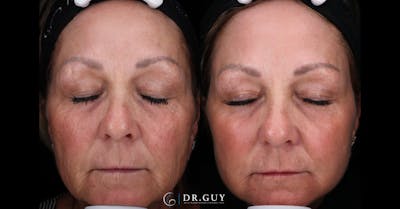 Laser Before & After Gallery - Patient 468220 - Image 1