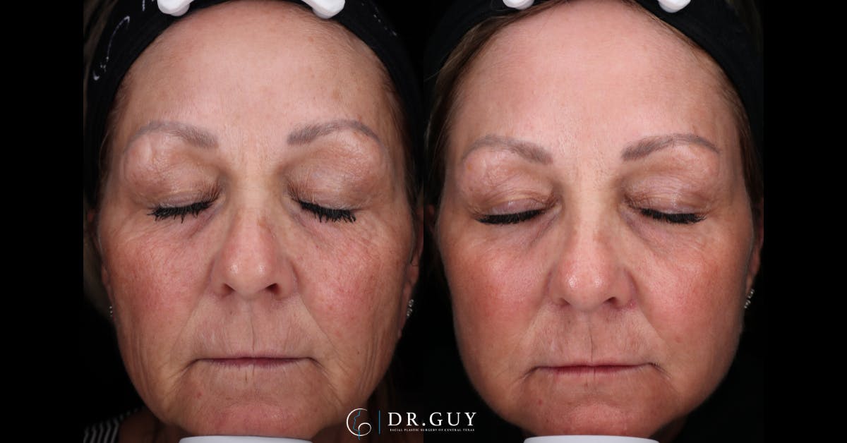 Laser Before & After Gallery - Patient 468220 - Image 1