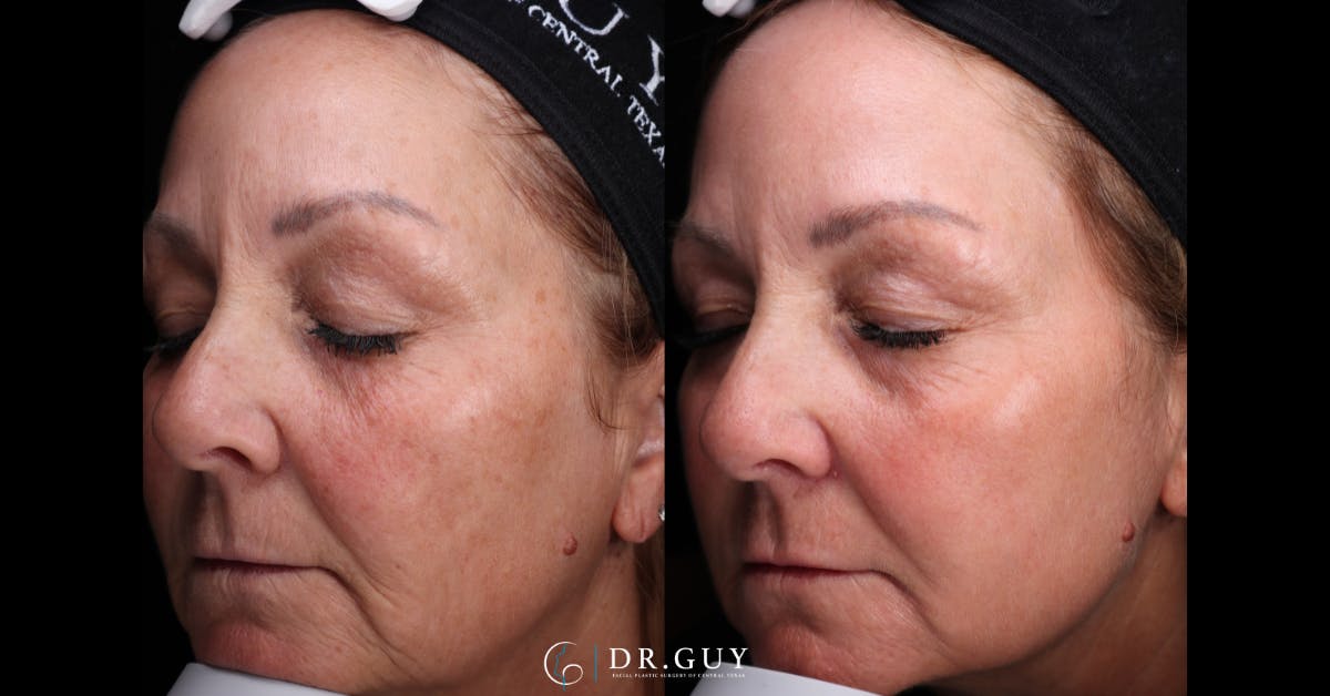 Laser Before & After Gallery - Patient 468220 - Image 3