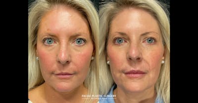 Fillers Before & After Gallery - Patient 350629 - Image 1