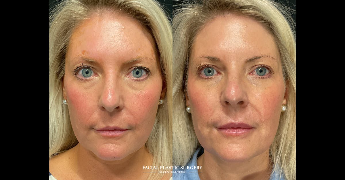 Fillers Before & After Gallery - Patient 350629 - Image 1