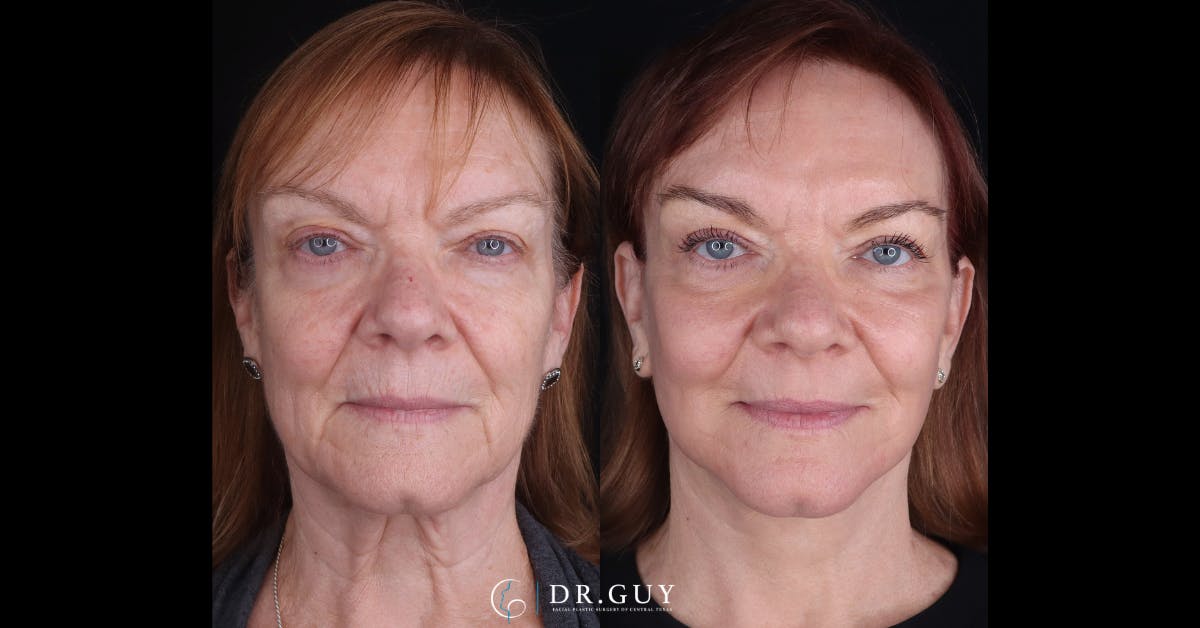 Laser Before & After Gallery - Patient 236911 - Image 1