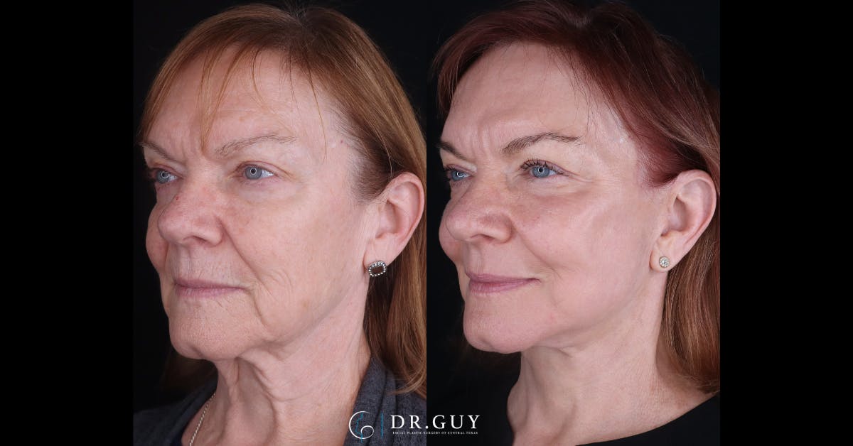 Laser Before & After Gallery - Patient 236911 - Image 3
