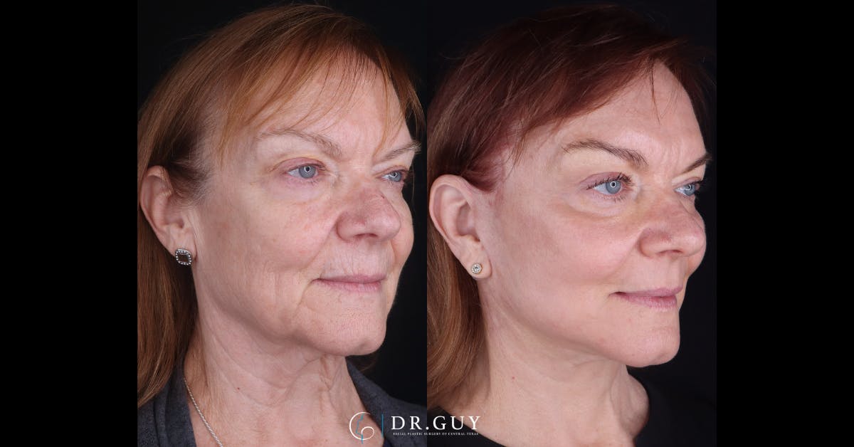 Laser Before & After Gallery - Patient 236911 - Image 2