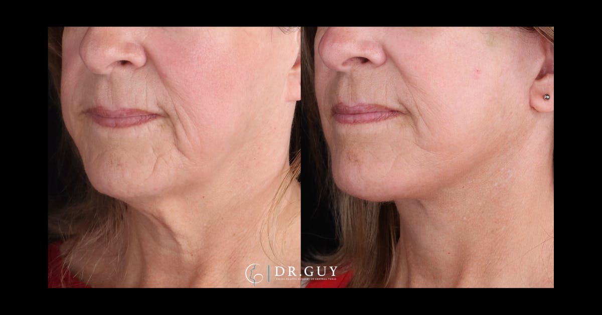 Facelift Before & After Gallery - Patient 315038 - Image 4