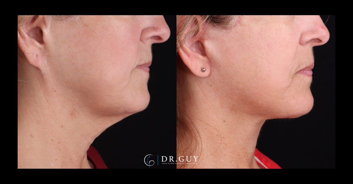 Facelift Before & After Gallery - Patient 315038 - Image 3