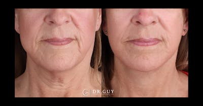 Facelift Before & After Gallery - Patient 315038 - Image 1