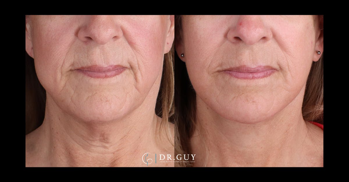 Facelift Before & After Gallery - Patient 315038 - Image 1