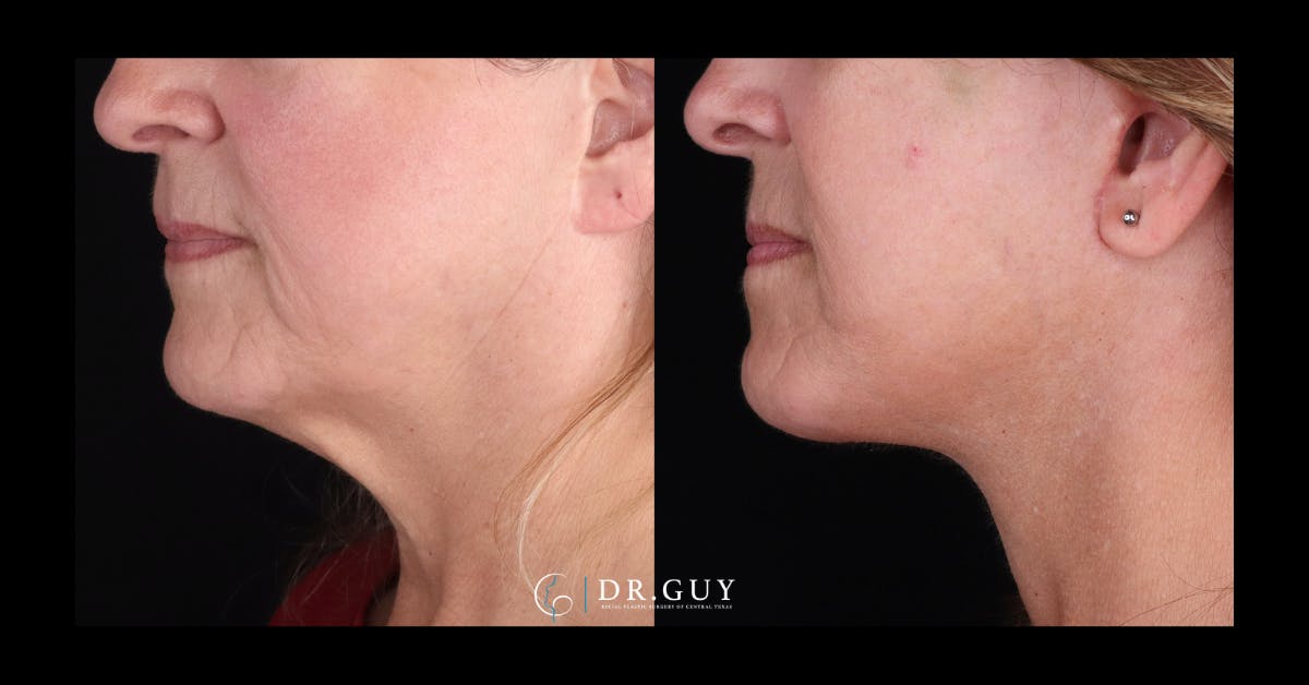 Facelift Before & After Gallery - Patient 315038 - Image 5