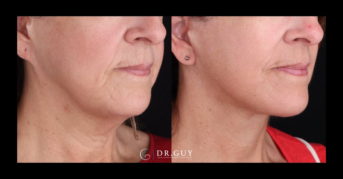 Facelift Before & After Gallery - Patient 315038 - Image 2