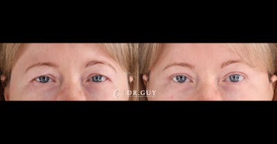 Upper Blepharoplasty Before & After Gallery - Patient 887374 - Image 1