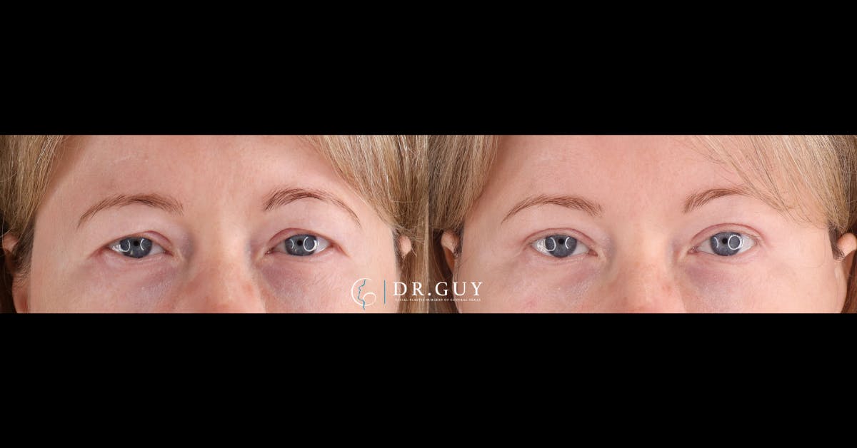 Upper Blepharoplasty Before & After Gallery - Patient 887374 - Image 1