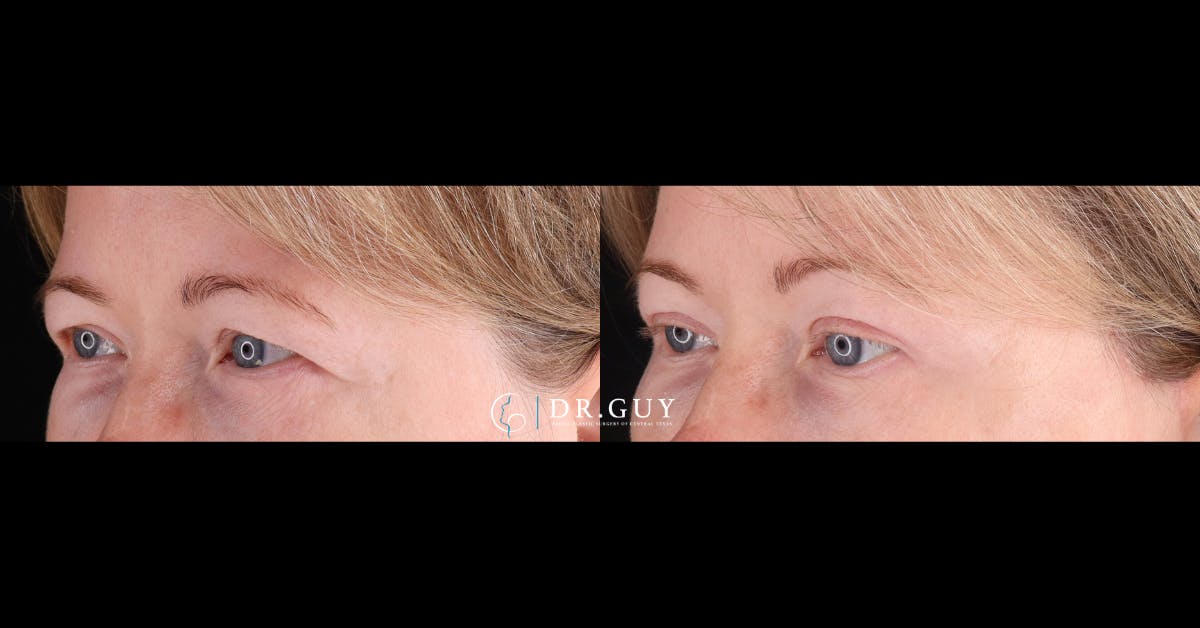 Upper Blepharoplasty Before & After Gallery - Patient 887374 - Image 2
