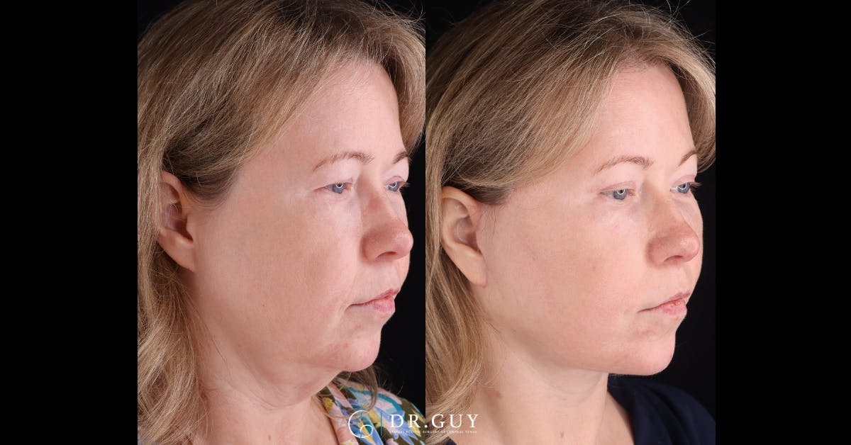 Facelift Before & After Gallery - Patient 402963 - Image 2