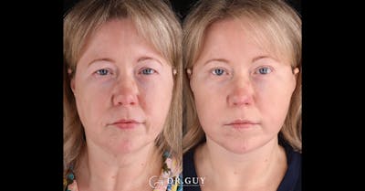 Facelift Before & After Gallery - Patient 402963 - Image 1