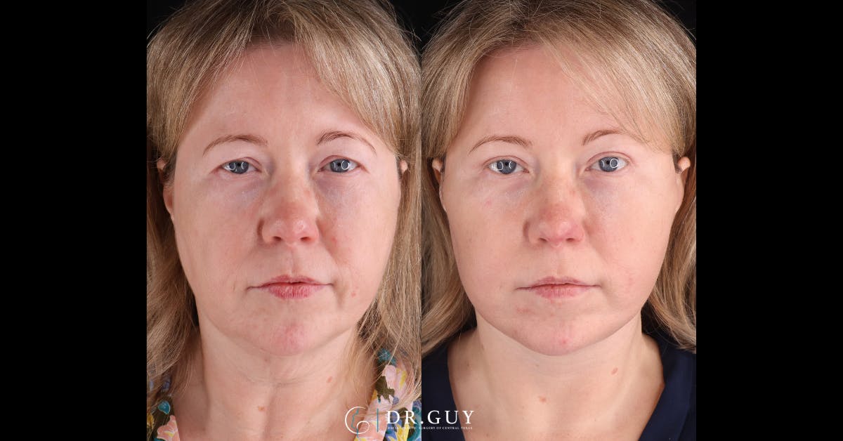 Facelift Before & After Gallery - Patient 402963 - Image 1