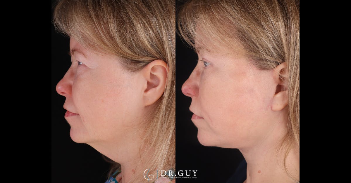 Facelift Before & After Gallery - Patient 402963 - Image 4