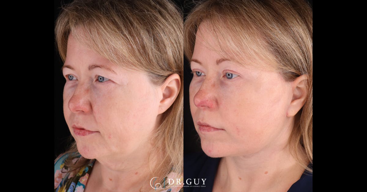 Facelift Before & After Gallery - Patient 402963 - Image 3