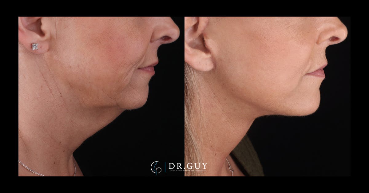 Facelift Before & After Gallery - Patient 403099 - Image 2