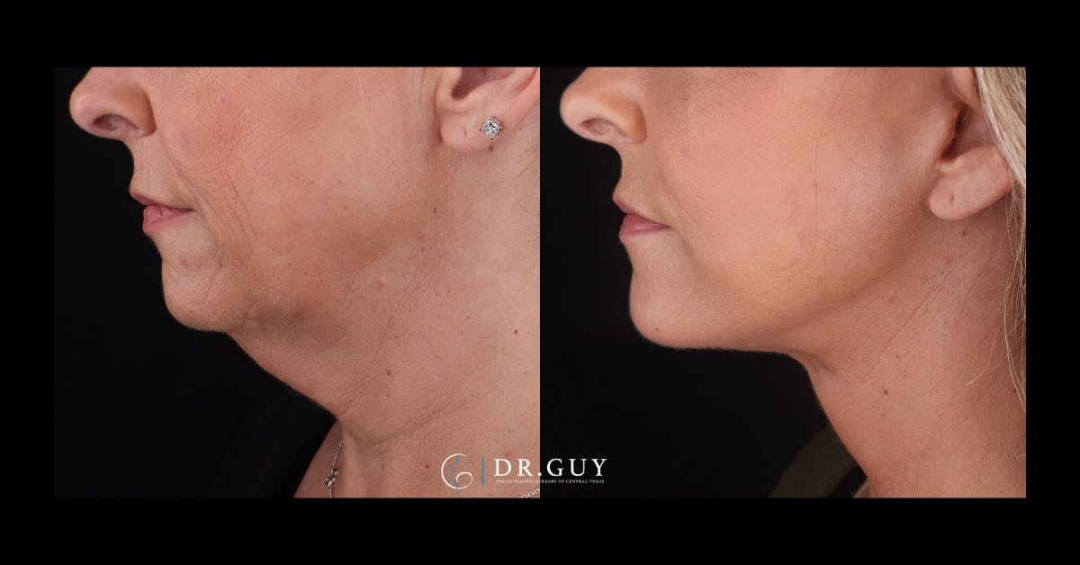 Facelift Before & After Gallery - Patient 403099 - Image 4