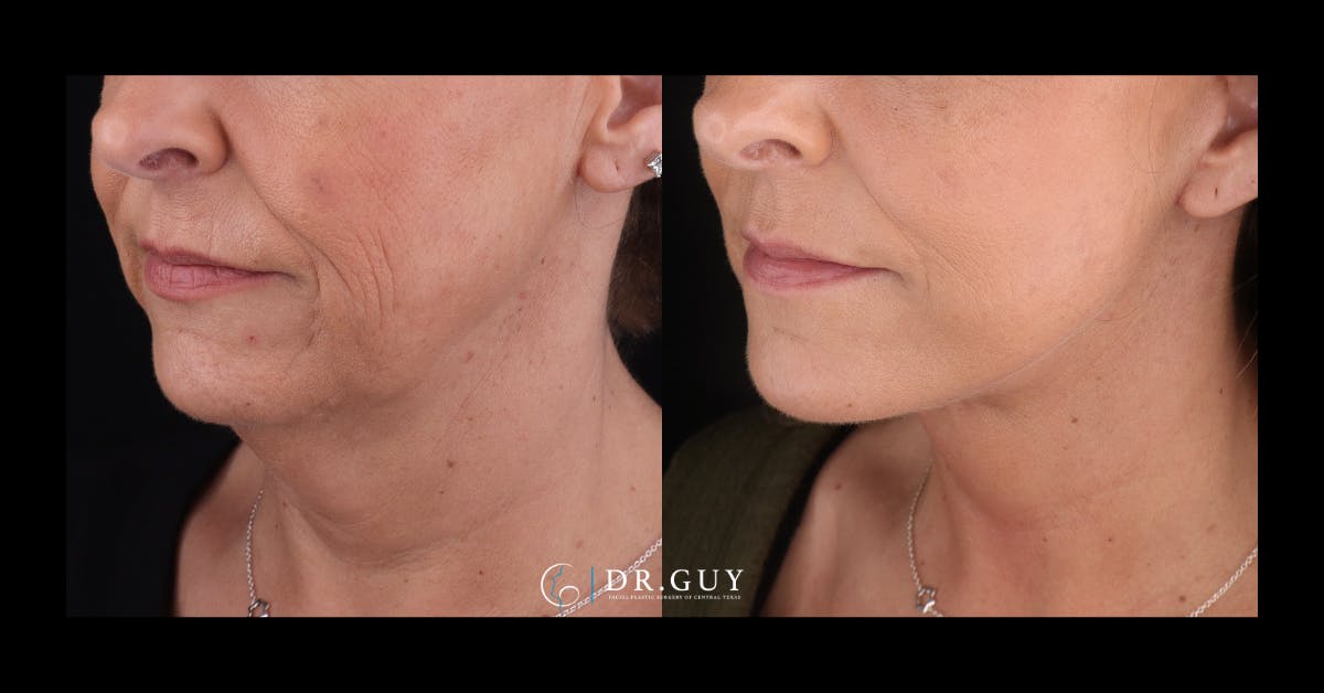 Facelift Before & After Gallery - Patient 403099 - Image 3