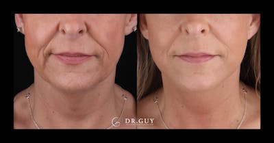 Facelift Before & After Gallery - Patient 403099 - Image 1