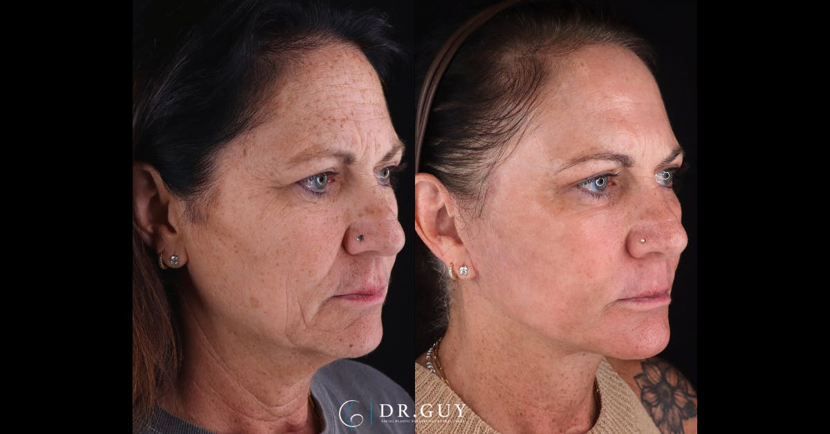 Facelift Before & After Gallery - Patient 422434 - Image 2
