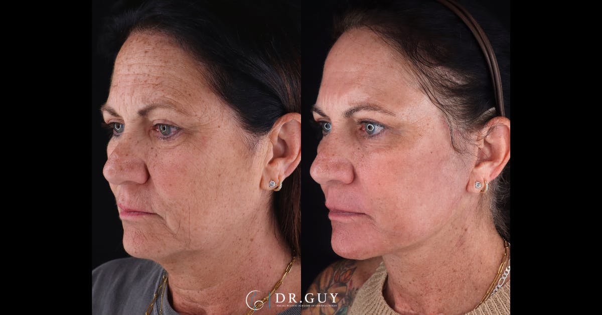 Facelift Before & After Gallery - Patient 422434 - Image 4