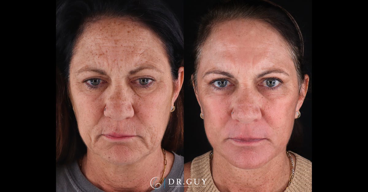 Facelift Before & After Gallery - Patient 422434 - Image 1