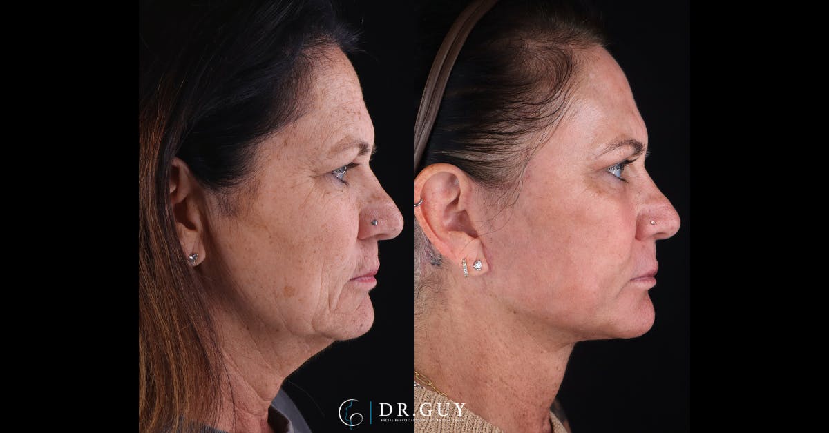 Facelift Before & After Gallery - Patient 422434 - Image 3