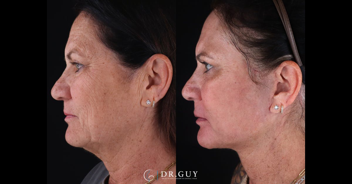Facelift Before & After Gallery - Patient 422434 - Image 5