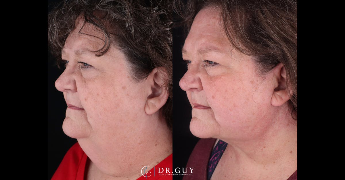 Neck Lift Before & After Gallery - Patient 743902 - Image 2