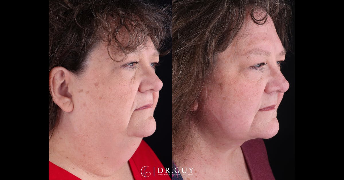 Neck Lift Before & After Gallery - Patient 743902 - Image 1
