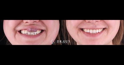 Scar Revision Before & After Gallery - Patient 292017 - Image 1