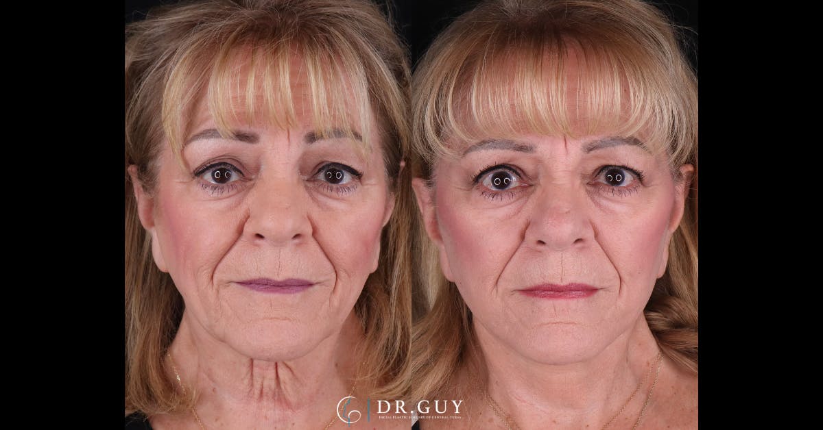 Facelift Before & After Gallery - Patient 521318 - Image 1