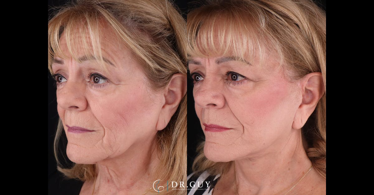 Facelift Before & After Gallery - Patient 521318 - Image 4